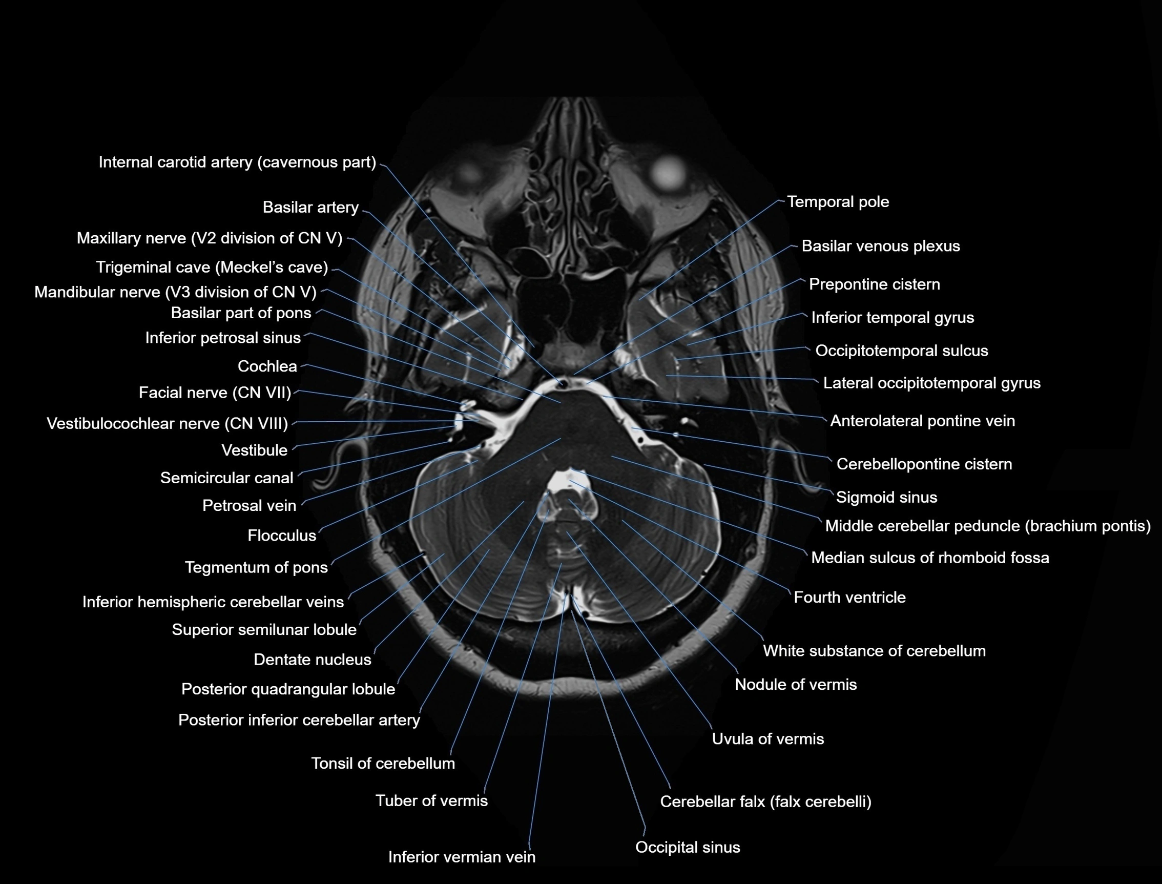 MRI Brain axial cross sectional radiology anatomy 3T image  -img-00001-00014.webp